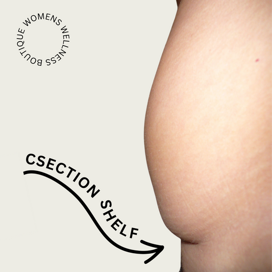 C-Section Pouches: The Role of Scar Formation and Adhesions